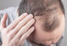 Muči vas opadanje kose? Otkrijte uzroke i prirodna rješenja! Muškarac dodiruje glavu pokazujući područje prorjeđene kose na tjemenu, što ukazuje na opadanje kose.