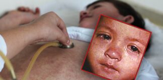 U Teksasu zabeleženo 198 slučajeva malih boginja