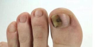 Ovo je najbolji lijek za onihomikozu: pomiješajte ove sastojke i potopite prste i nestat će preko noći Ovo je najbolji lijek za onihomikozu: pomiješajte ove sastojke i potopite prste i nestat će preko noći - featured image