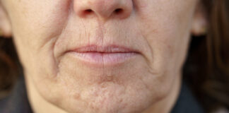 Simptom DEMENCIJE koji se javlja u ustima: Ako ga osjetite, obratite se ljekaru! Simptom DEMENCIJE koji se javlja u ustima: Ako ga osjetite, obratite se ljekaru! - featured image